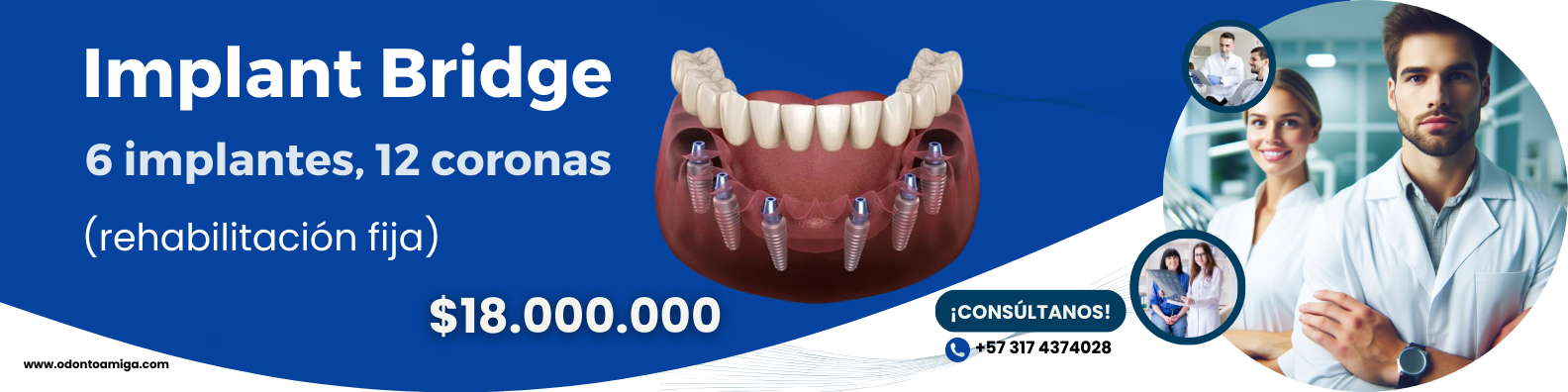 Banner Implant Bridge